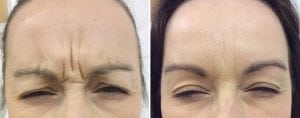 womans forehead with wrinkles before and with out wrinkles after Botox