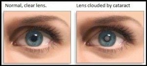What’s the difference between LenSx and LASIK?