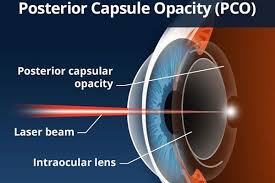 diagram of the eye illustrating YAG laser capsulotomy