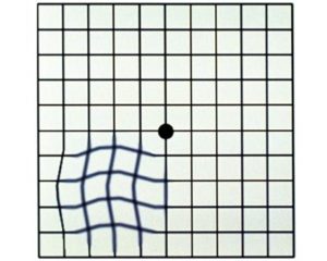 grid box with wavy lines simulating vision loss from AMD